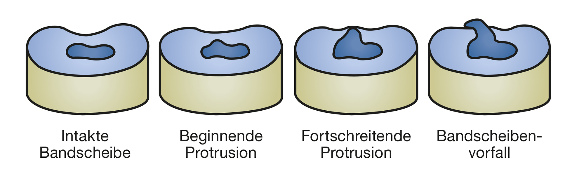 Wie entsteht ein Bandscheibenvorfall?