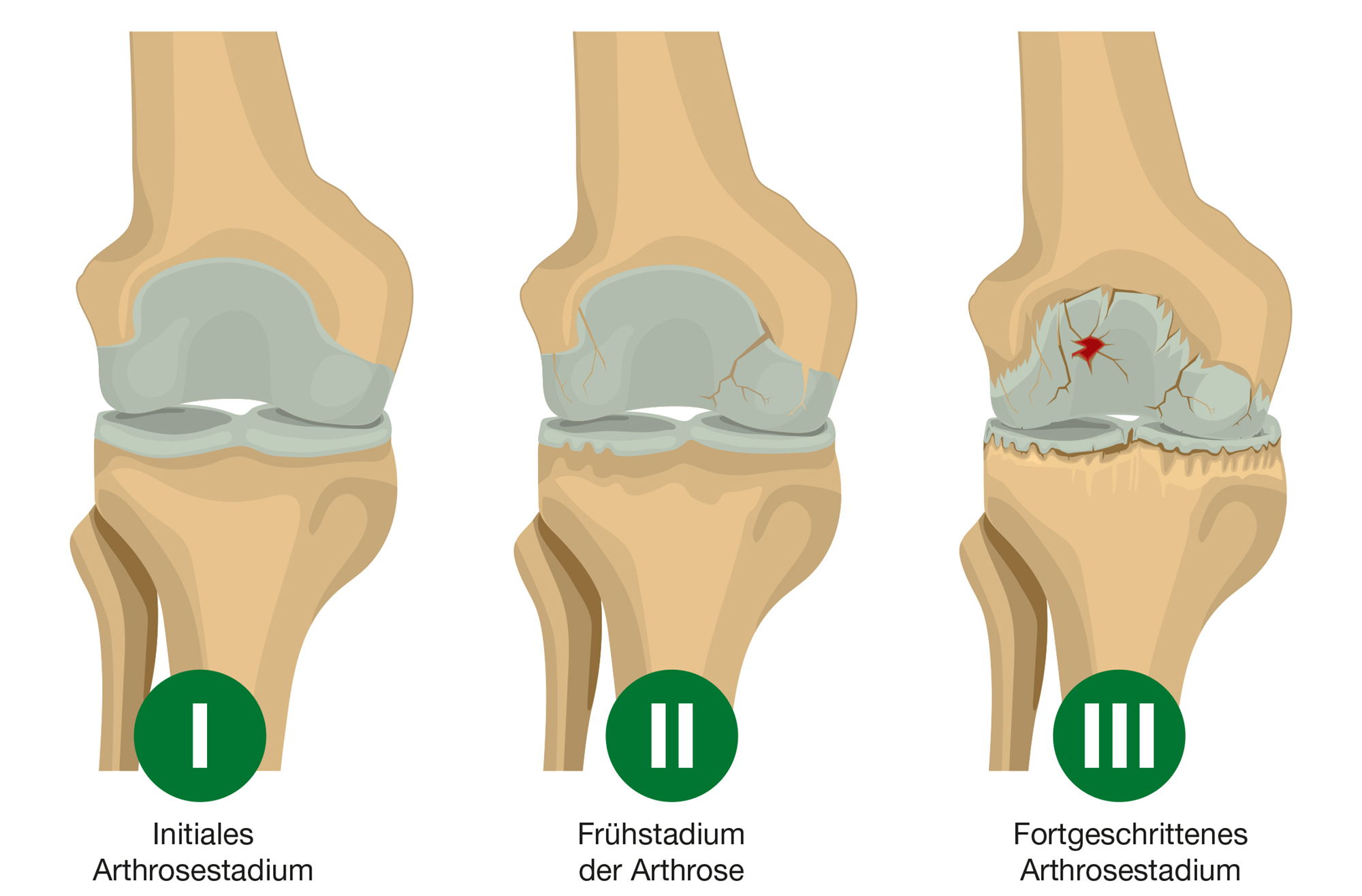 Die 3 Stadien der Arthrose