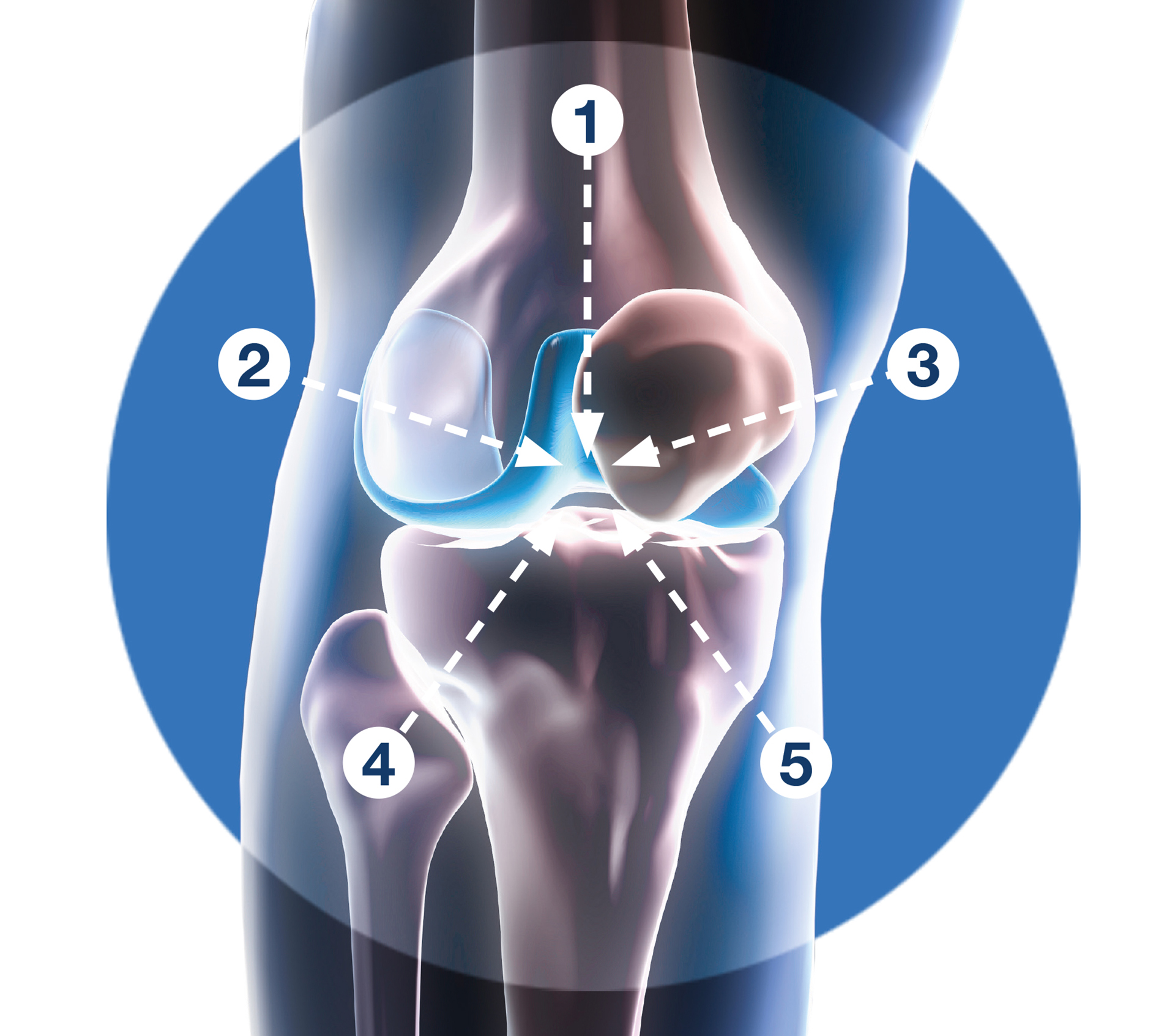 Welche Nährstoffe bei Arthrose?